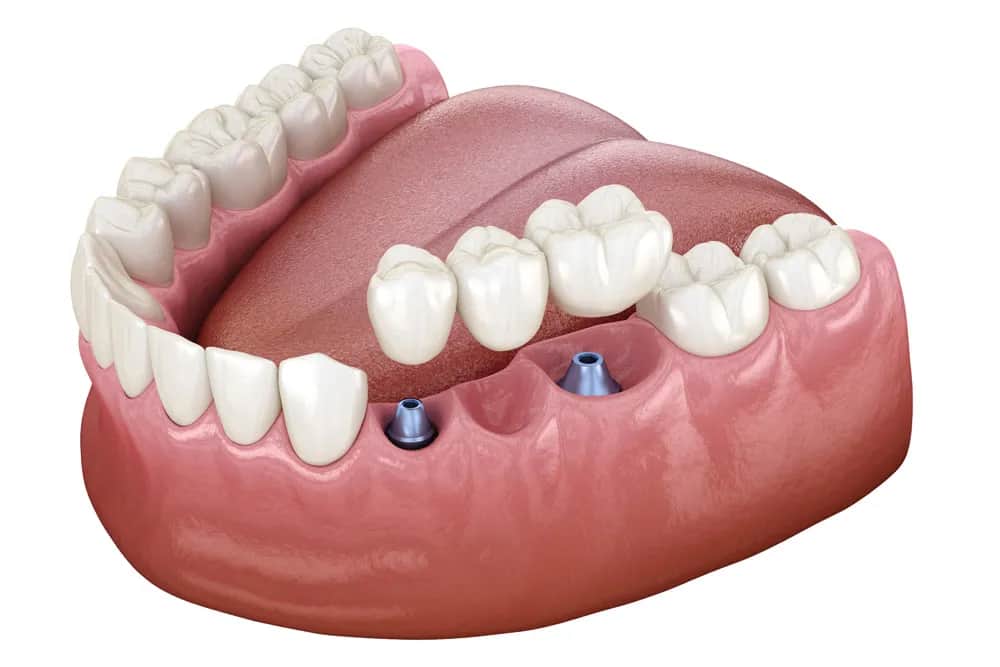 Ile kosztuje mostek na 3 zęby? Sprawdź ceny i opcje leczenia