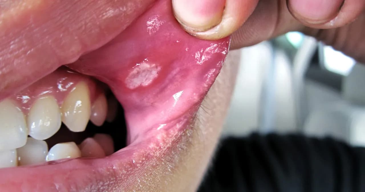 Jak długo trwa afta na dziąśle? Poznaj przyczyny i czas gojenia