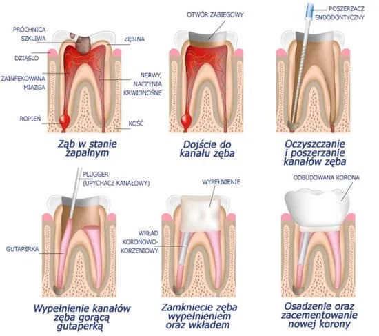 Przepełnienie kanału zęba objawy: jak rozpoznać i uniknąć bólu