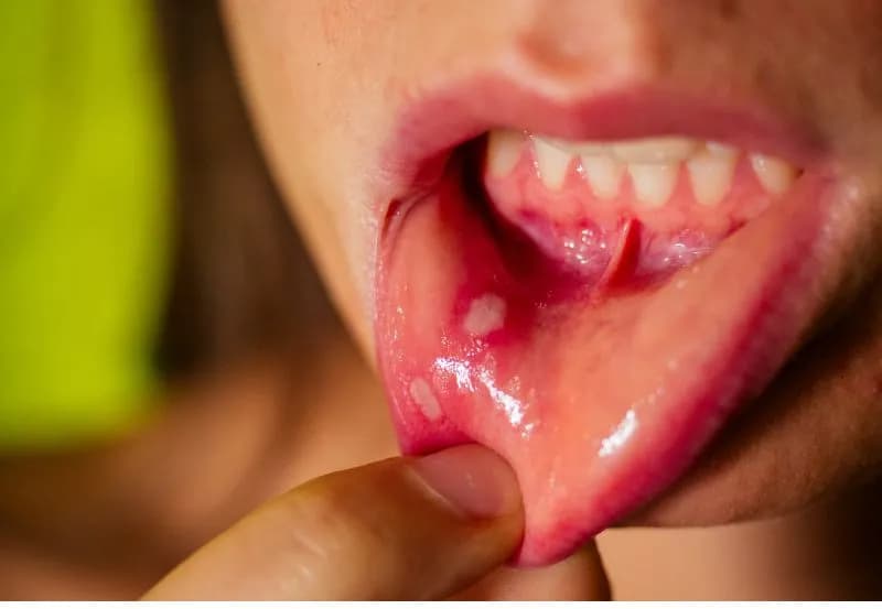 Opryszczkowe zapalenie jamy ustnej u dzieci - ile trwa i co robić?