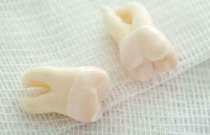 Dlaczego boli dziąsło po wyrwaniu zęba? Sprawdź, co jest normalne.