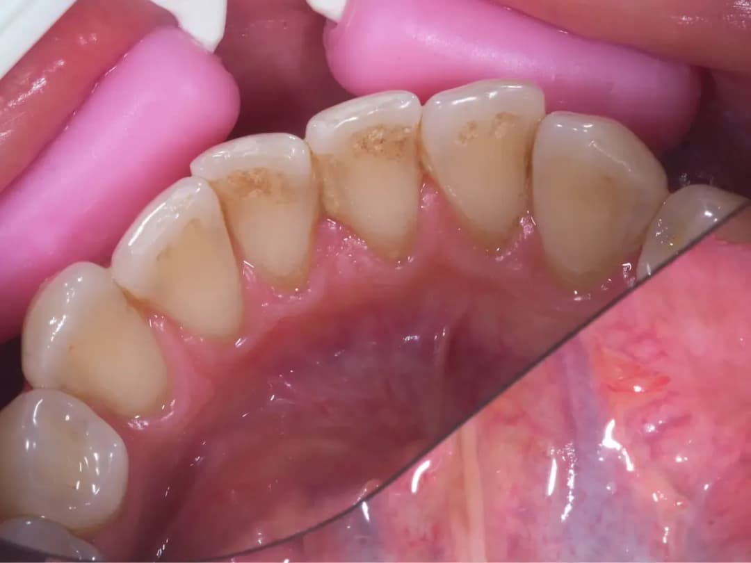 Jak wygląda kamień na zębach? Objawy i skutki zdrowotne