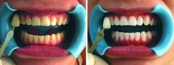 Jak wygląda wybielanie zębów u dentysty? Poznaj szczegóły i efekty