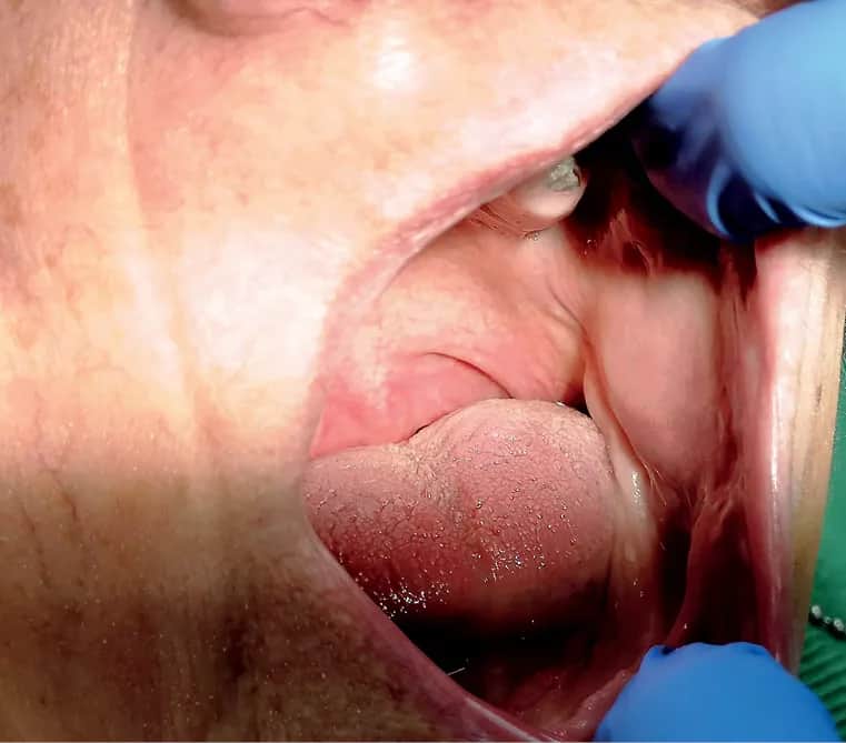 Włókniak jamy ustnej objawy: co powinieneś wiedzieć o zmianach?