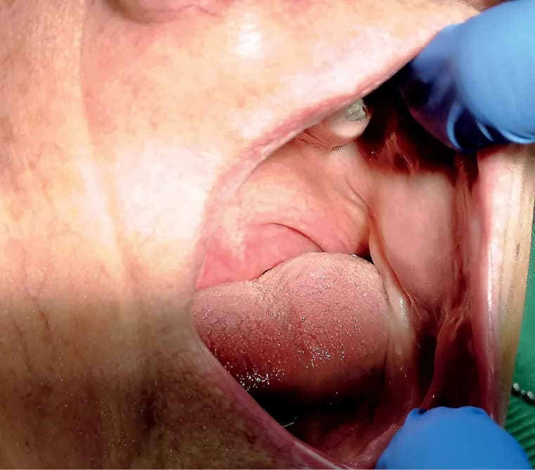 Włókniak jamy ustnej objawy: co powinieneś wiedzieć o zmianach?