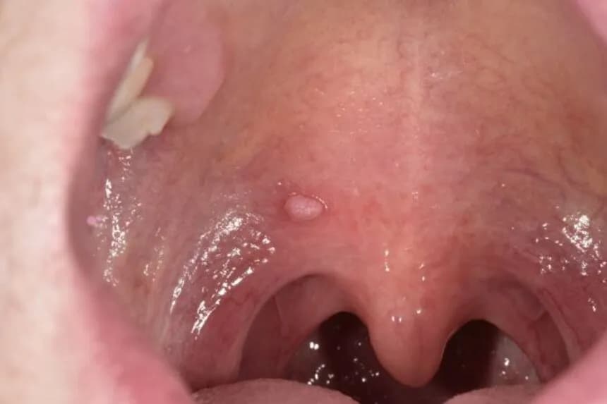 Objawy HPV w jamie ustnej: Jak rozpoznać i uniknąć poważnych problemów