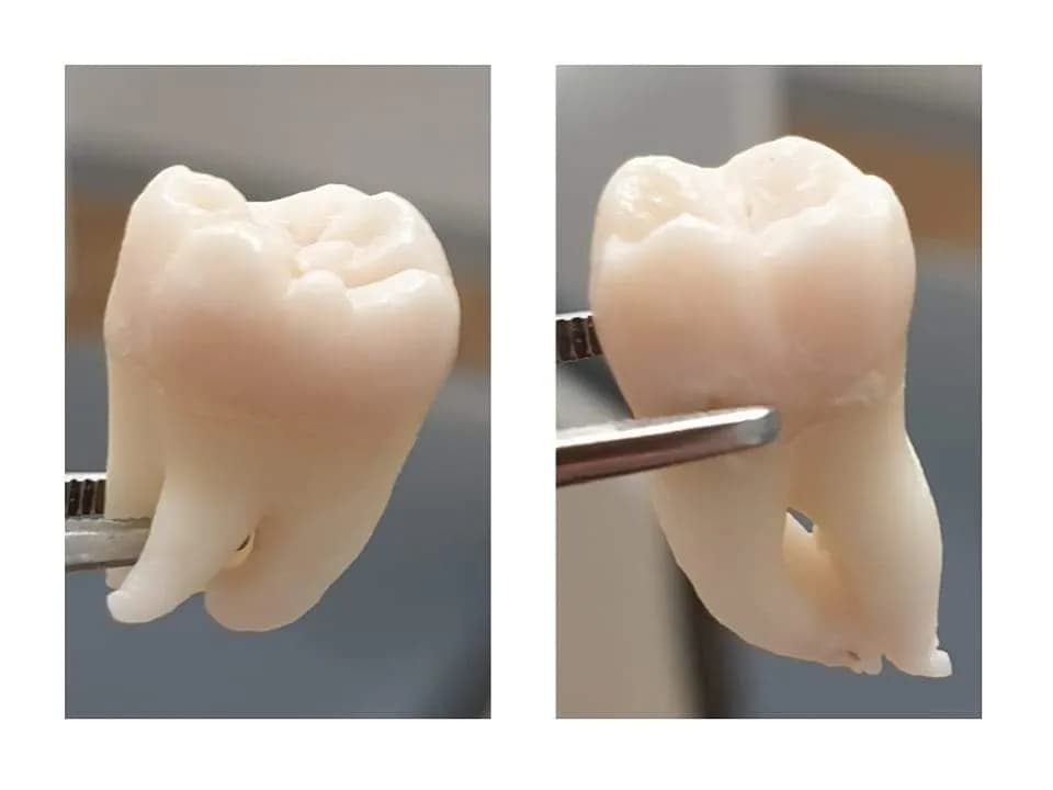 Zęby trzonowe – jakie to zęby i dlaczego są tak ważne dla zdrowia?